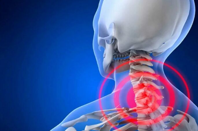 Osteohondroza grlića maternice