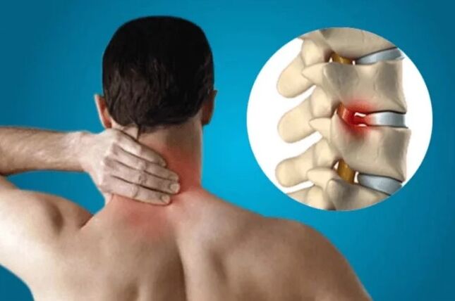 Osteohondroza kralježnice