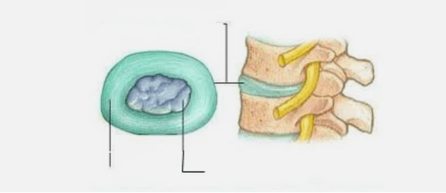Priroda osteohondroze